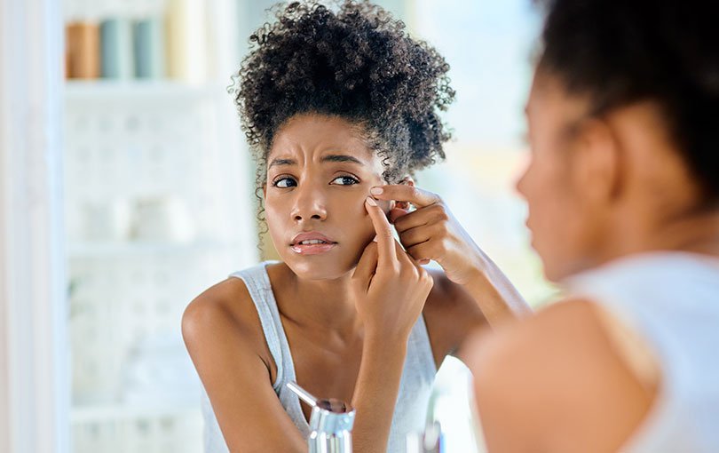 Acne & Acne Scars