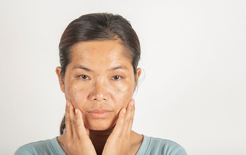 Textured or hyper-pigmented skin
