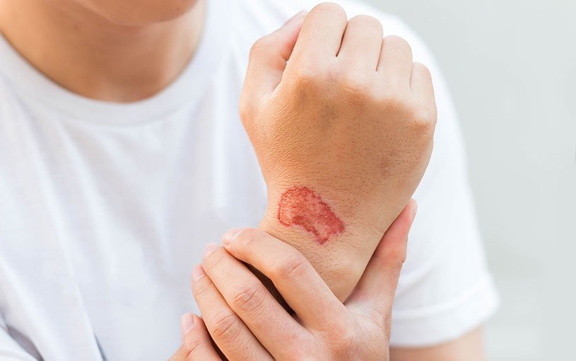 Skin Lesions