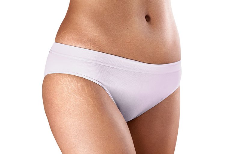 Stretch Marks