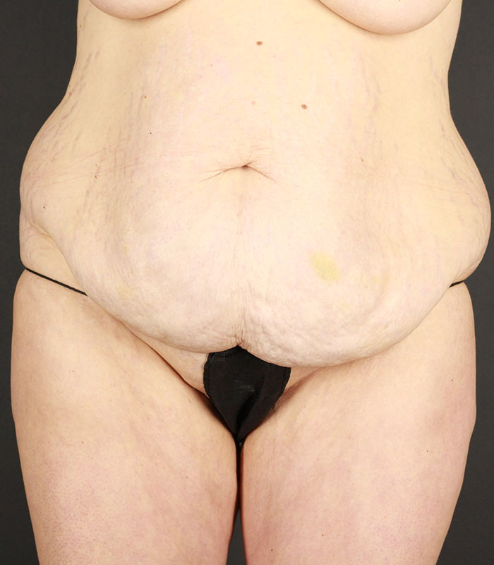 Body Lift Before & After Image