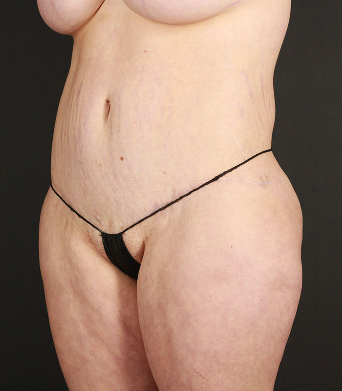 Body Lift Before & After Image