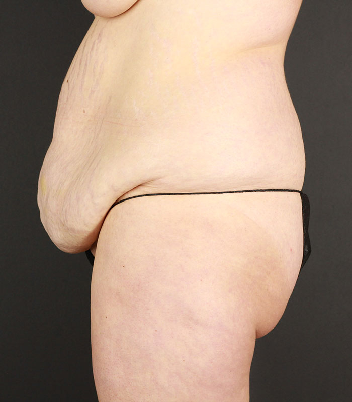 Body Lift Before & After Image