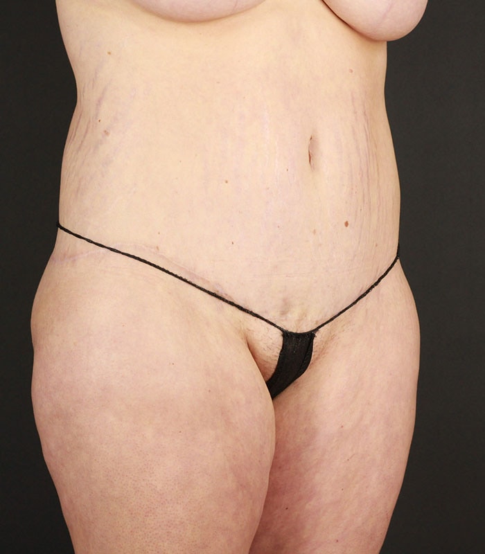 Body Lift Before & After Image
