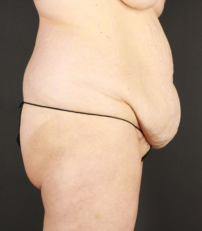 Body Lift Before & After Image