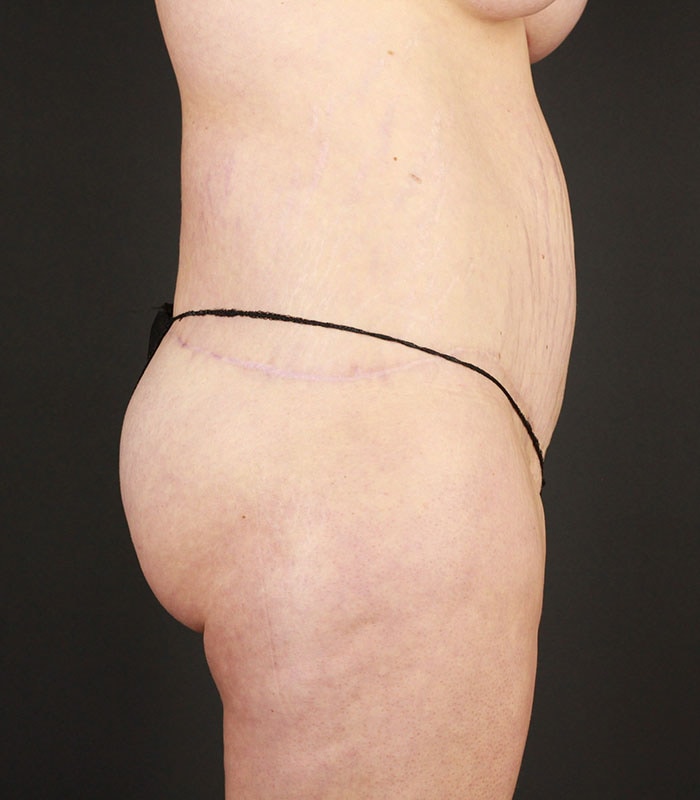 Body Lift Before & After Image
