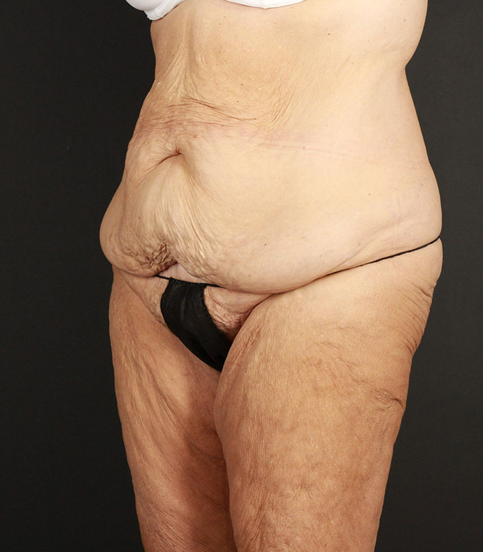 Body Lift Before & After Image