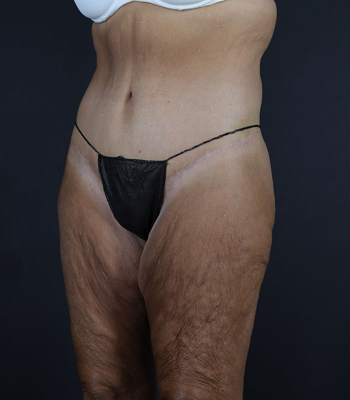 Body Lift Before & After Image