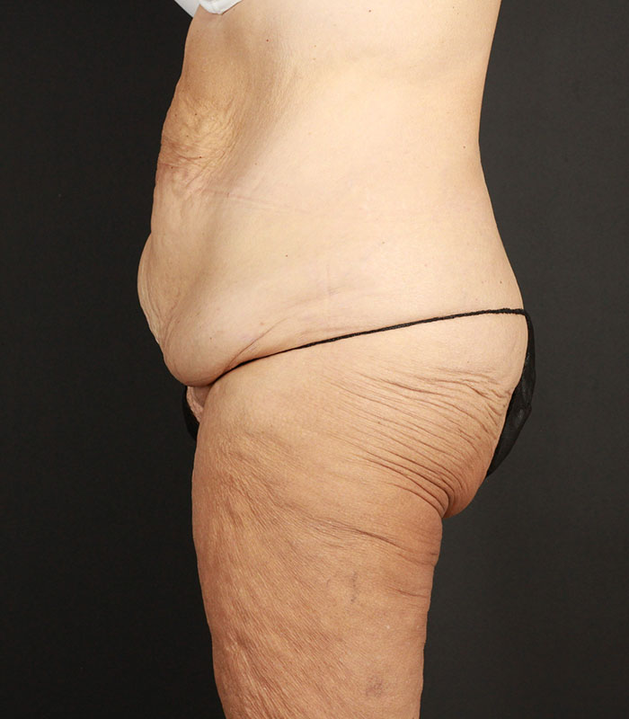 Body Lift Before & After Image