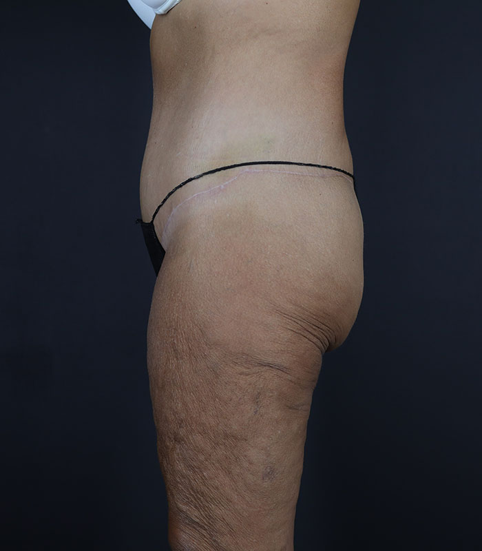 Body Lift Before & After Image
