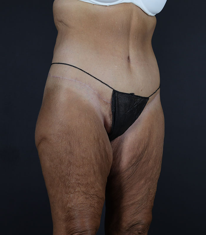Body Lift Before & After Image