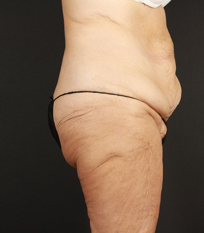 Body Lift Before & After Image