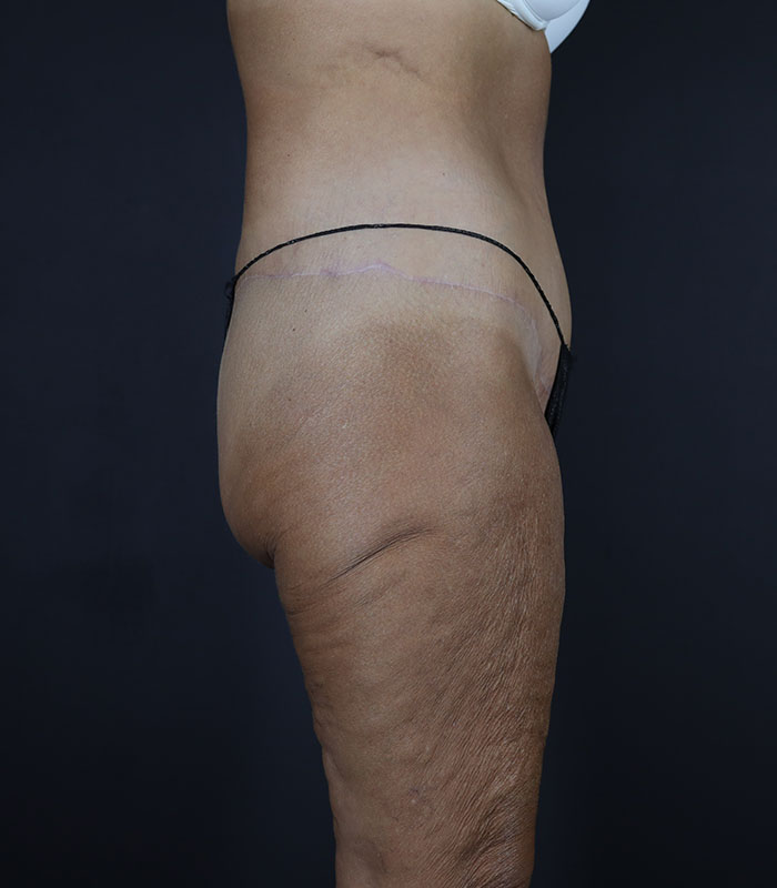 Body Lift Before & After Image