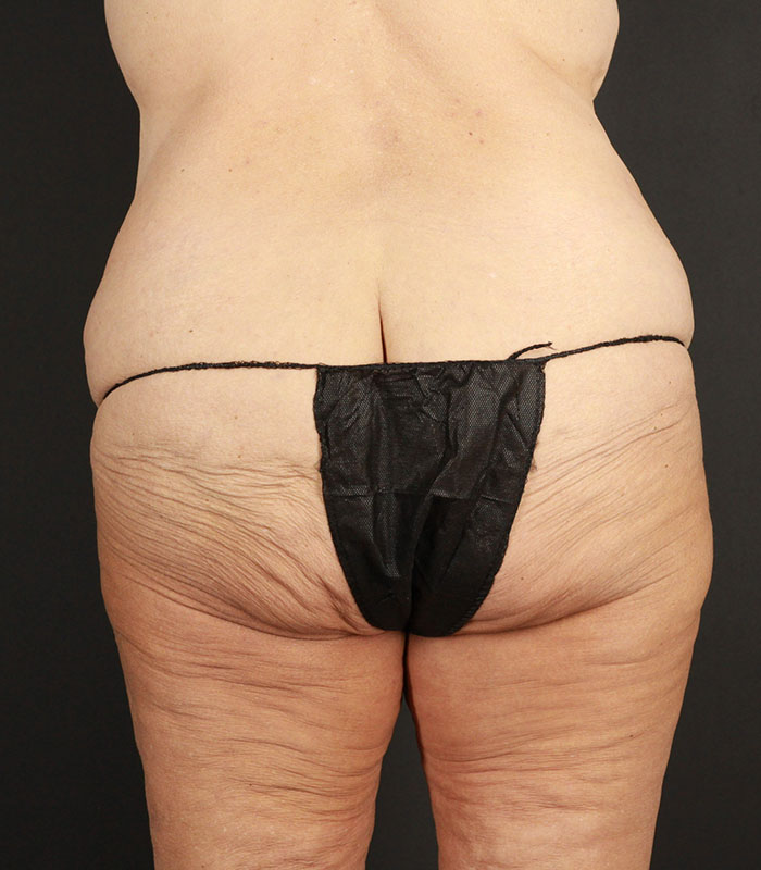 Body Lift Before & After Image
