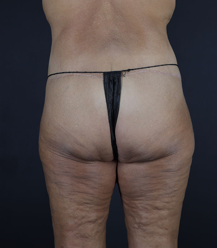 Body Lift Before & After Image