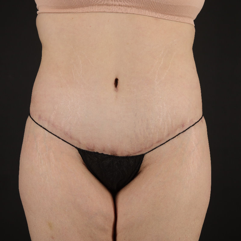 Body Lift Before & After Image