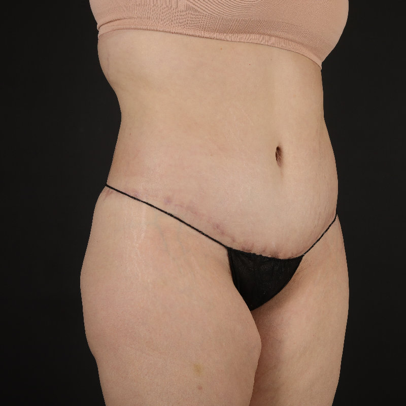 Body Lift Before & After Image