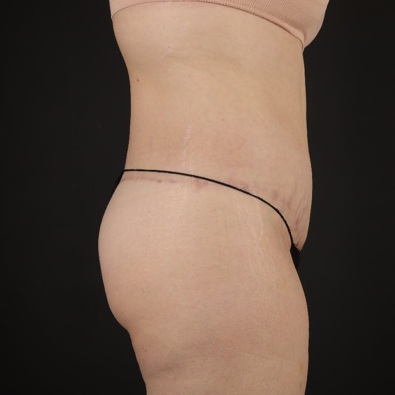 Body Lift Before & After Image