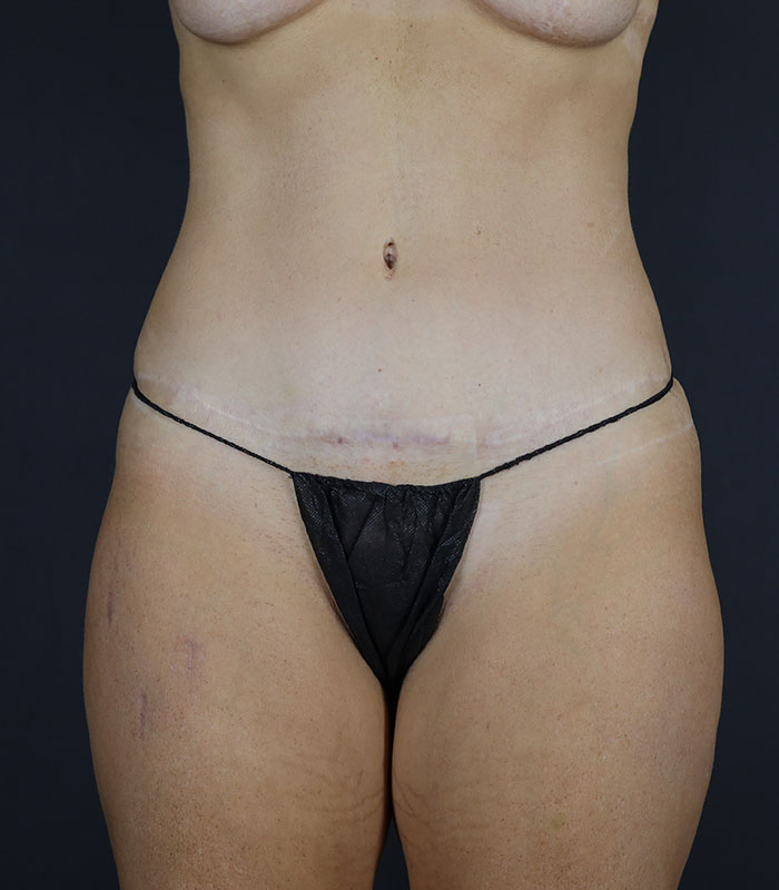 Liposuction Before & After Image