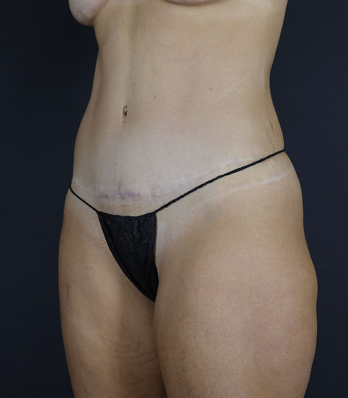 Liposuction Before & After Image