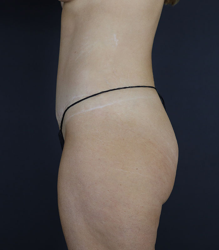 Liposuction Before & After Image