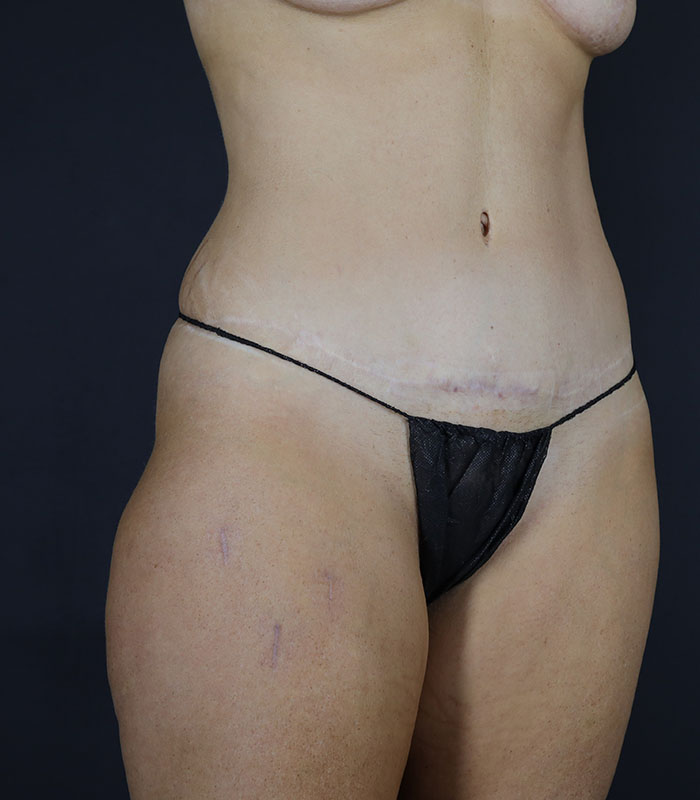 Liposuction Before & After Image