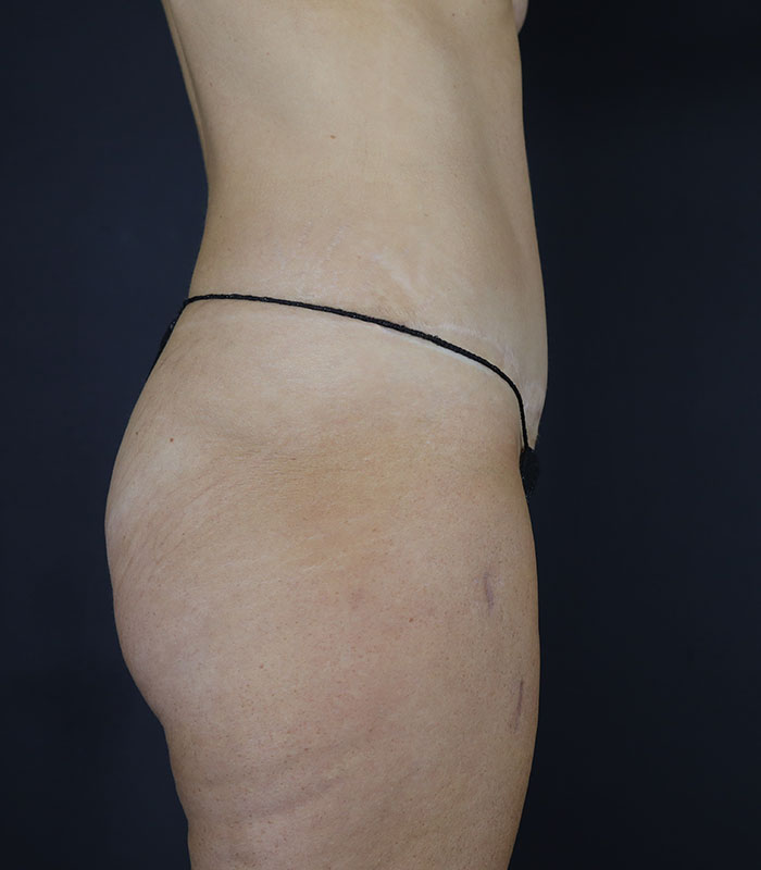 Liposuction Before & After Image