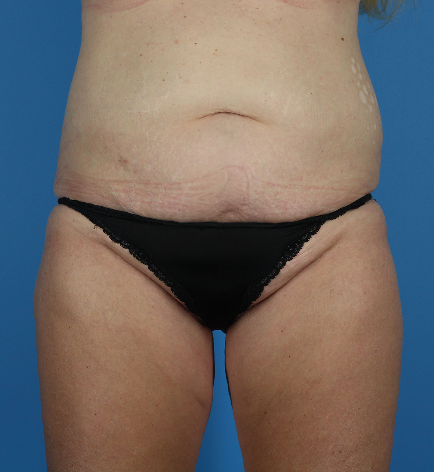 Arm-Lift and Thigh-Lift Before & After Image