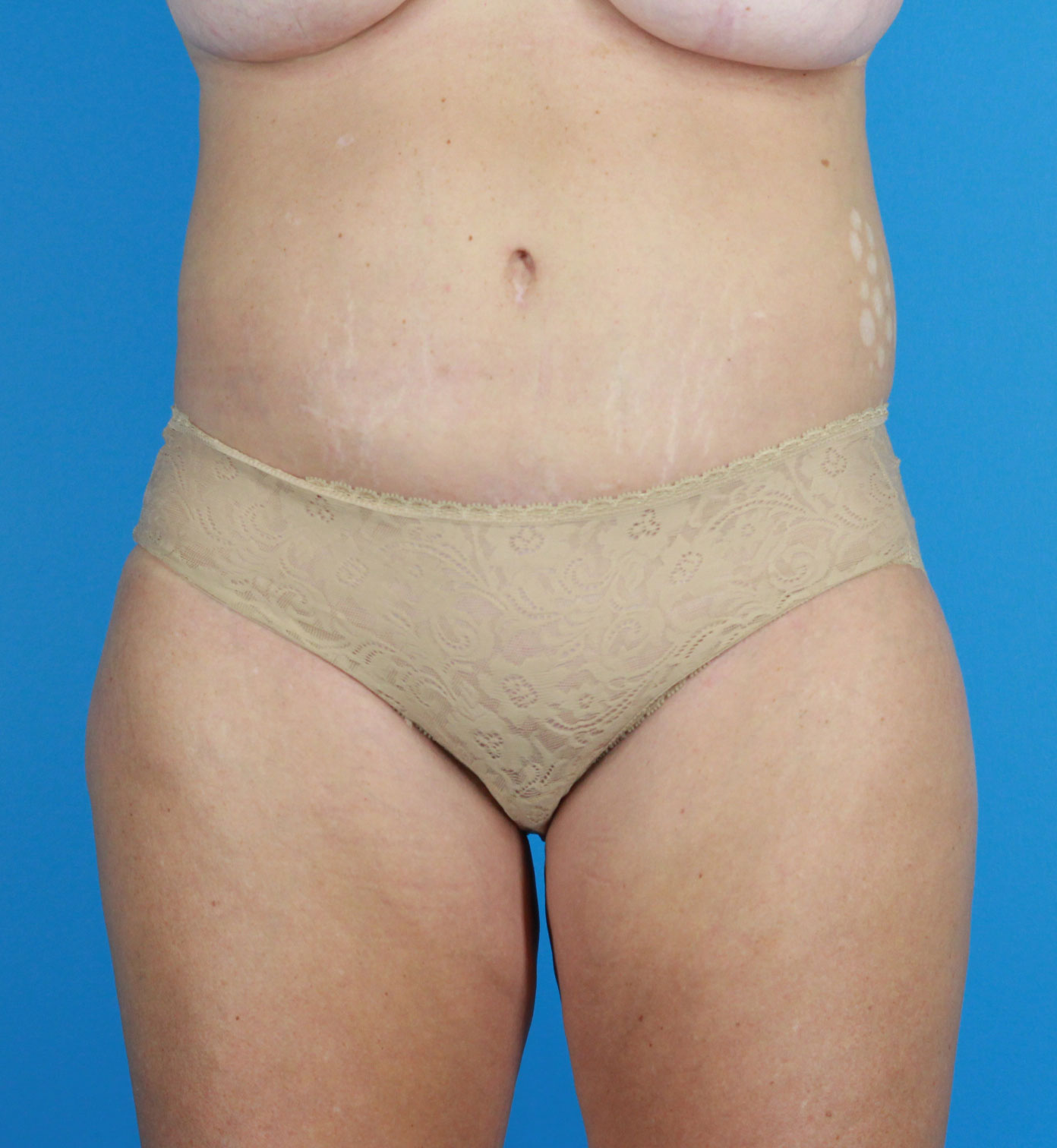 Arm-Lift and Thigh-Lift Before & After Image
