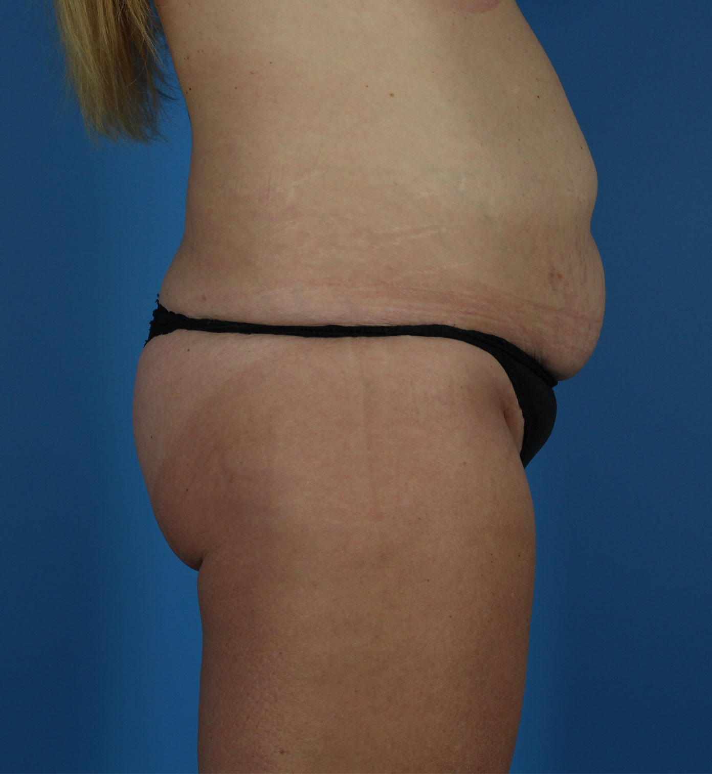 Arm-Lift and Thigh-Lift Before & After Image