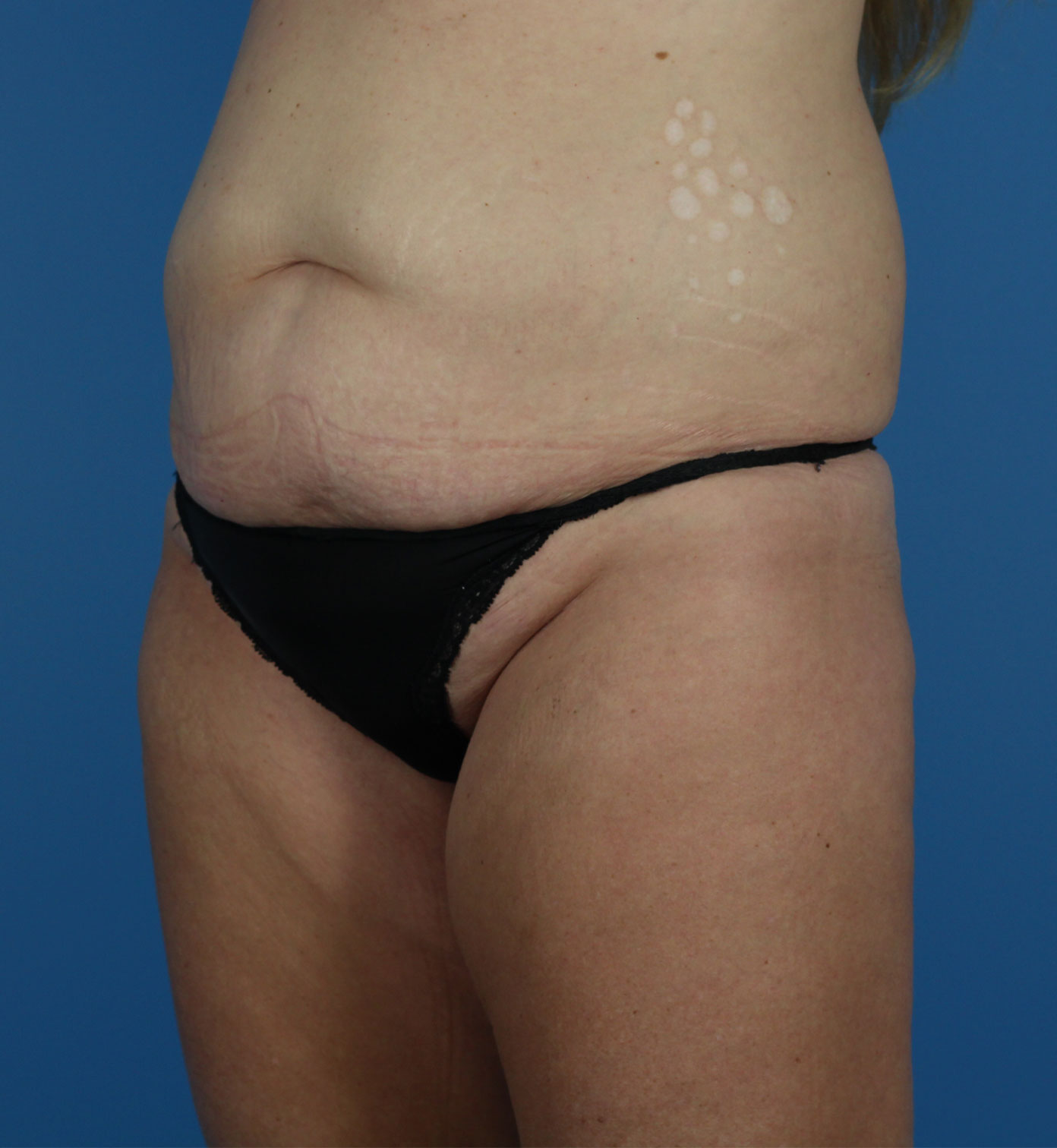 Arm-Lift and Thigh-Lift Before & After Image