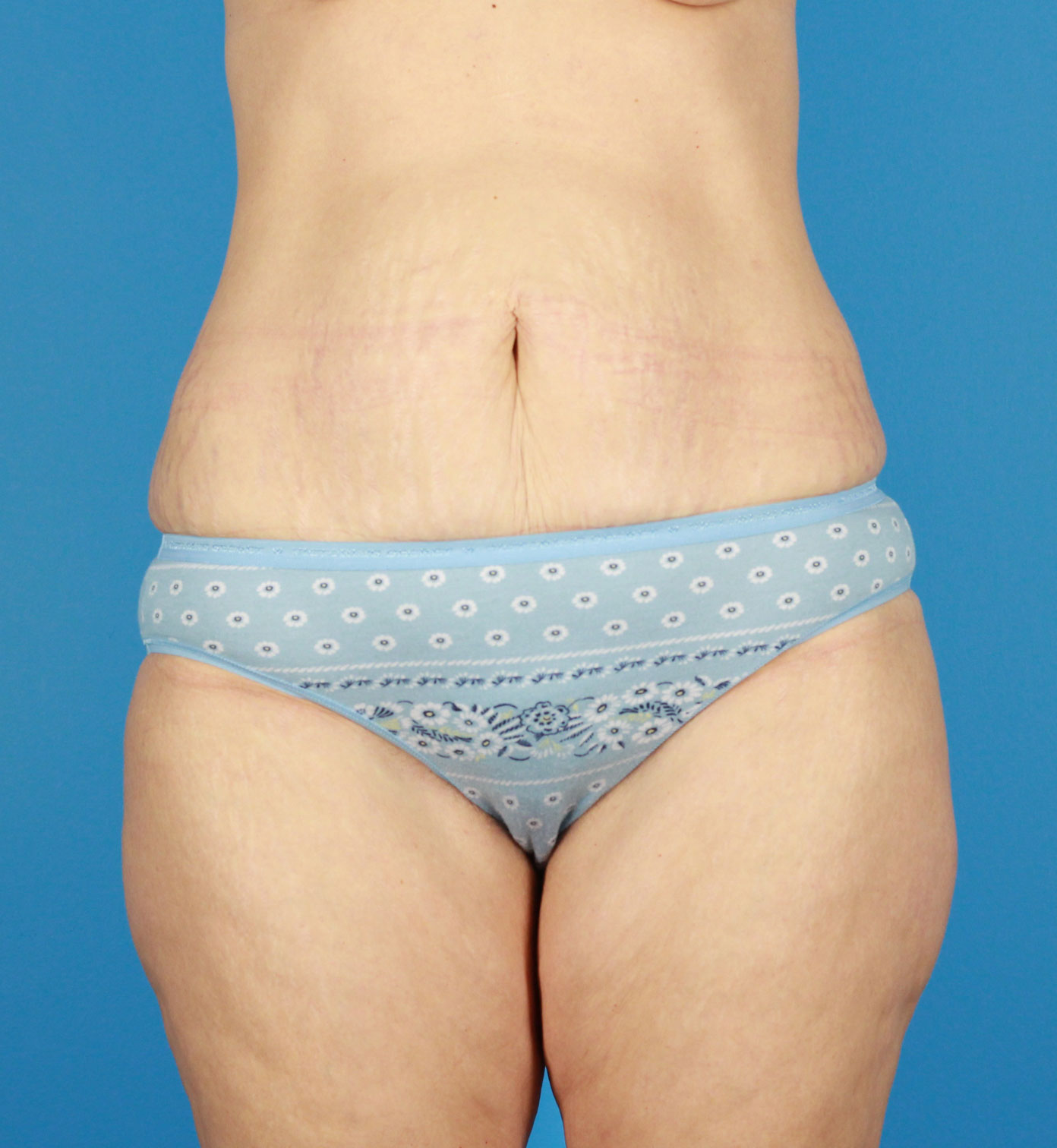 Arm-Lift and Thigh-Lift Before & After Image