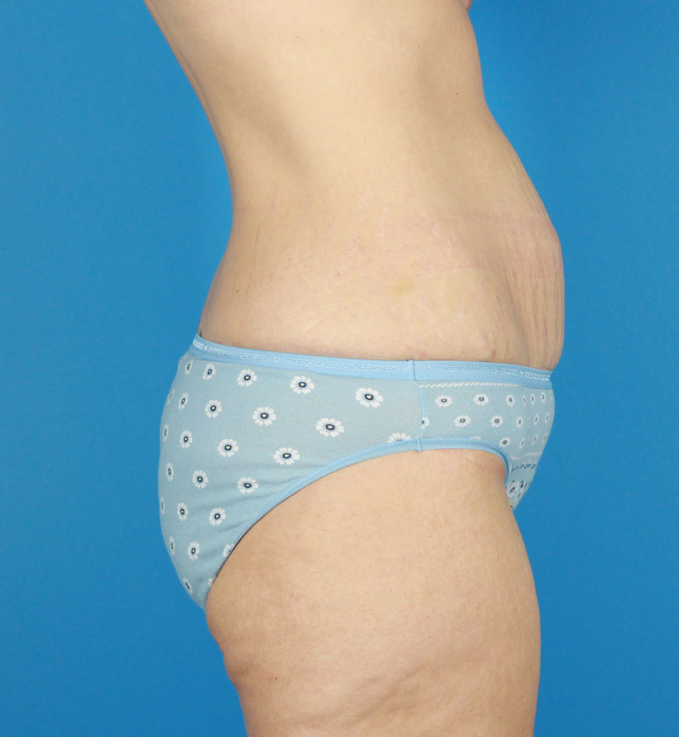 Arm-Lift and Thigh-Lift Before & After Image