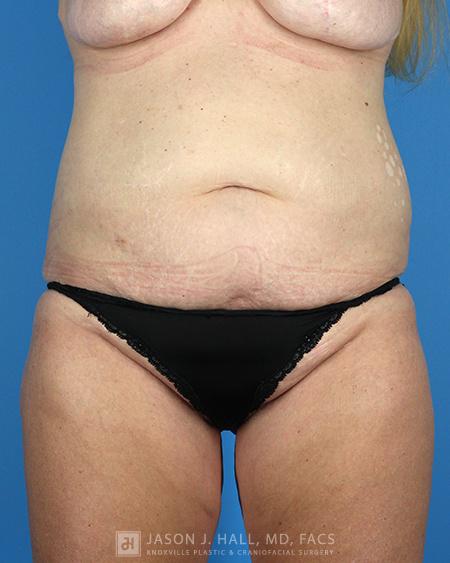 Arm-Lift and Thigh-Lift Before & After Image
