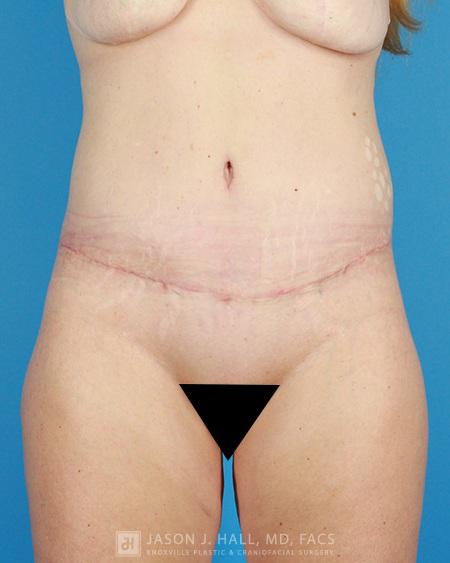 Arm-Lift and Thigh-Lift Before & After Image