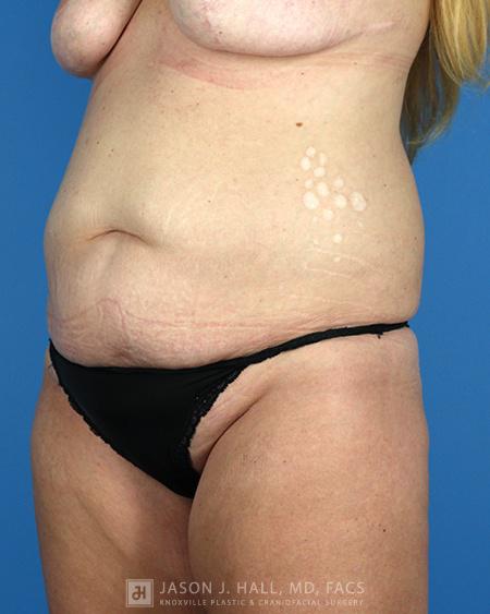Arm-Lift and Thigh-Lift Before & After Image