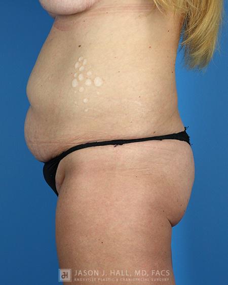 Arm-Lift and Thigh-Lift Before & After Image