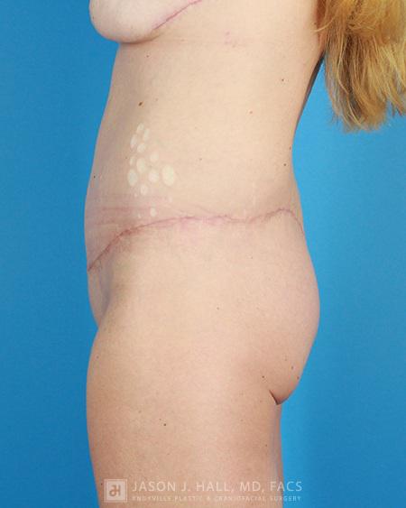 Arm-Lift and Thigh-Lift Before & After Image