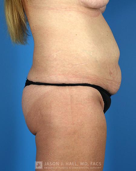 Arm-Lift and Thigh-Lift Before & After Image