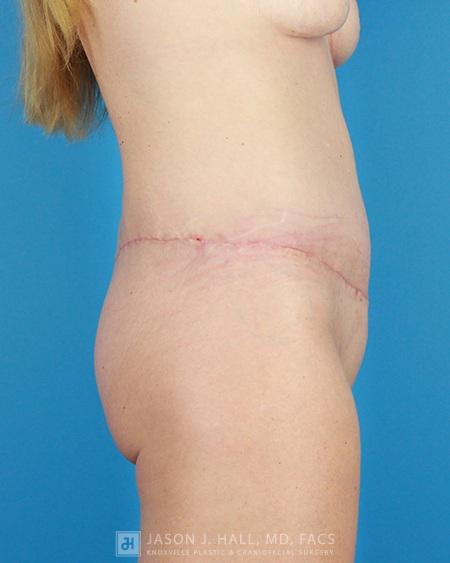 Arm-Lift and Thigh-Lift Before & After Image