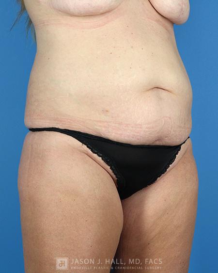 Arm-Lift and Thigh-Lift Before & After Image