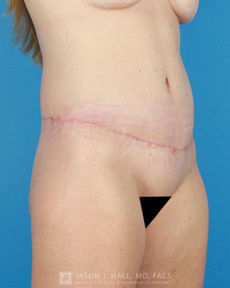 Arm-Lift and Thigh-Lift Before & After Image
