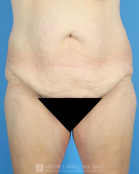 Arm-Lift and Thigh-Lift Before & After Image