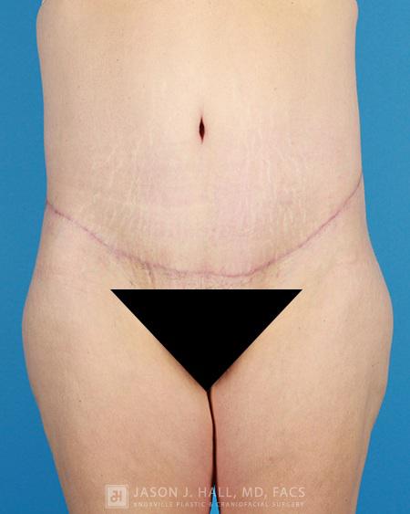 Arm-Lift and Thigh-Lift Before & After Image
