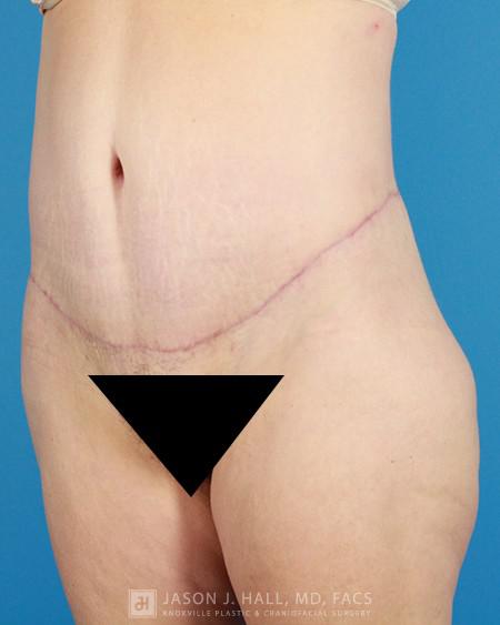 Arm-Lift and Thigh-Lift Before & After Image