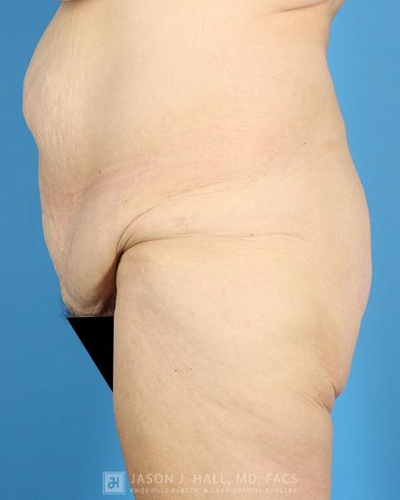 Arm-Lift and Thigh-Lift Before & After Image