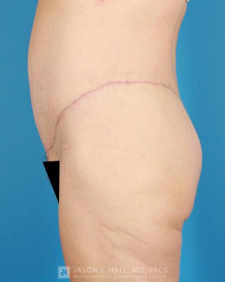 Arm-Lift and Thigh-Lift Before & After Image