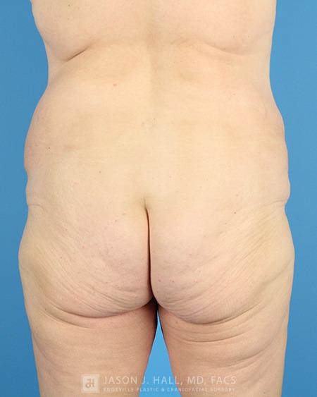 Arm-Lift and Thigh-Lift Before & After Image
