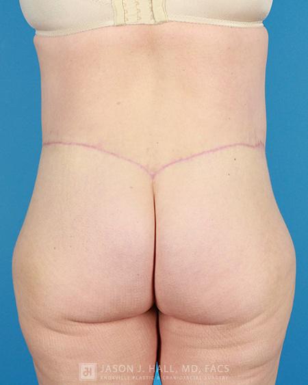 Arm-Lift and Thigh-Lift Before & After Image