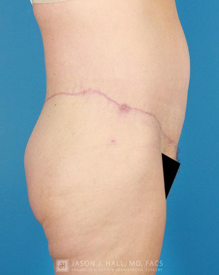 Arm-Lift and Thigh-Lift Before & After Image